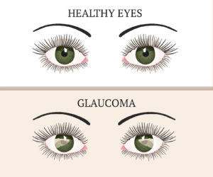 Image about Glaucoma In Elderly: Information For Our Loved Ones